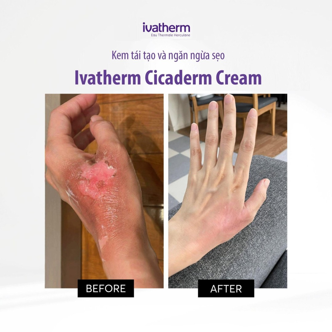 Kem phục hồi & tái tạo da sau điều trị – Ivatherm Cicaderm Cream 40ml
